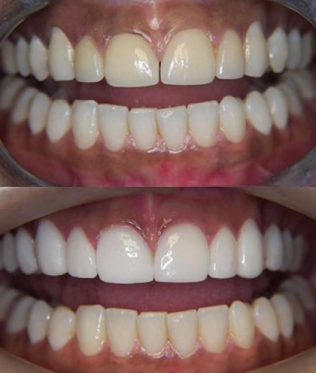 Fluoride Treatments in Gramercy Park