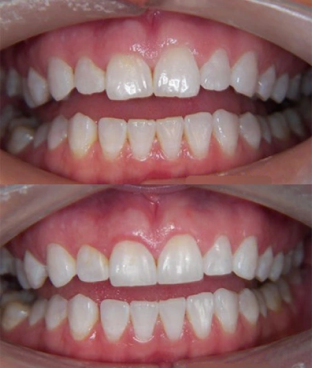 Tooth Extractions in East Village